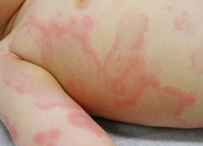 کهیر در کودکان و علائم آن